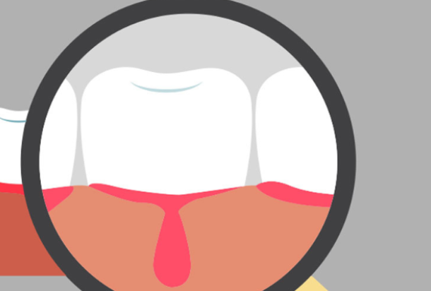 Por qué el sangrado de encías no es «normal» y cuándo acudir al dentista