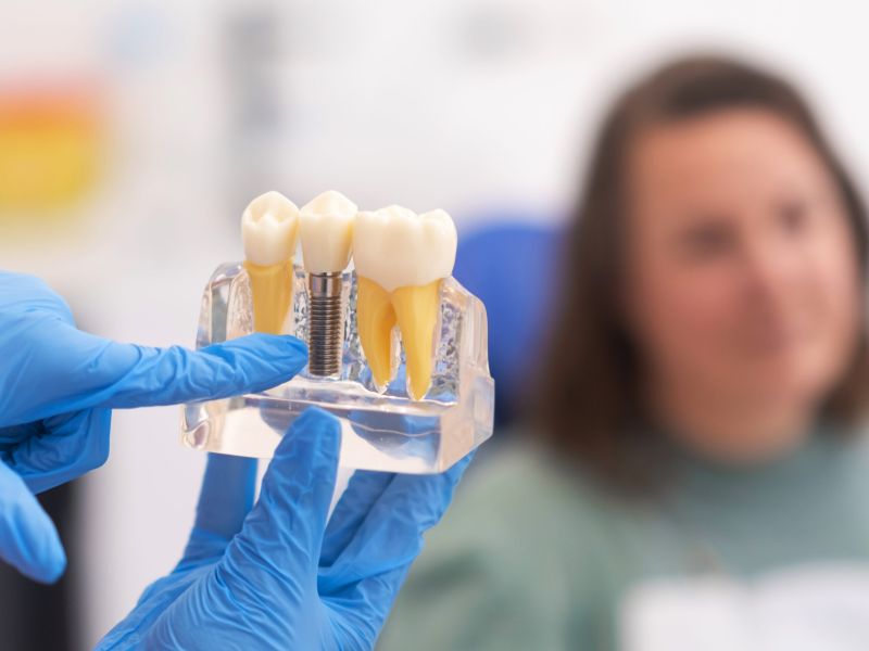 Implantes dentales en Sevilla: todo lo que debes saber antes del tratamiento