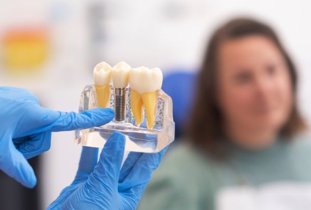 Implantes dentales en Sevilla: todo lo que debes saber antes del tratamiento