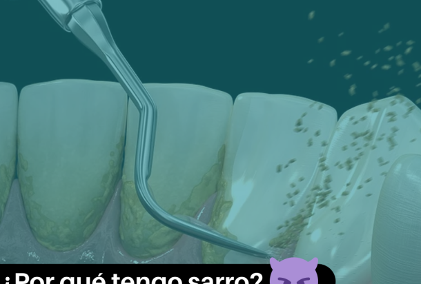 ¿Por qué tengo sarro?