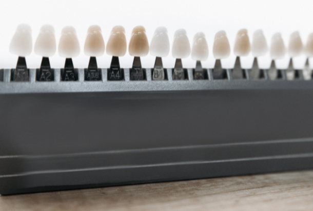 Carillas dentales: diferencias entre composite y porcelana, cuál elegir y por qué