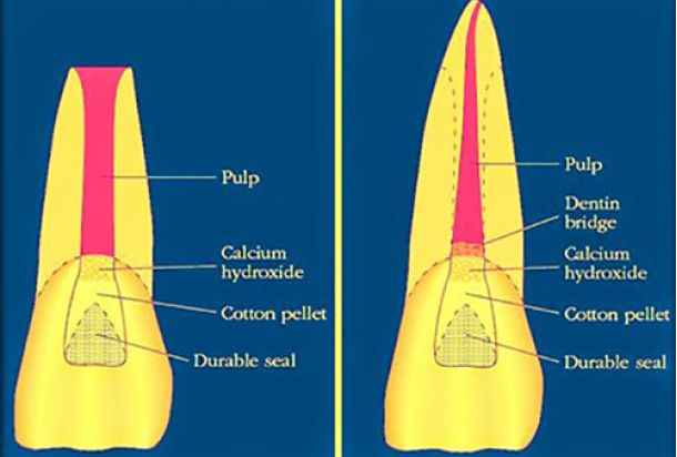 ¿Qué es la Revascularización dental?