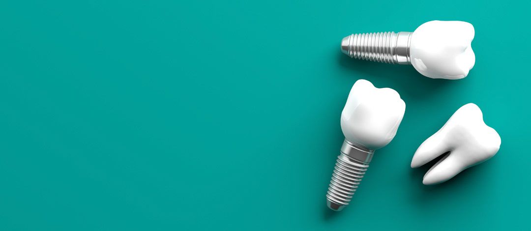 Implantología en Clínica Pastor