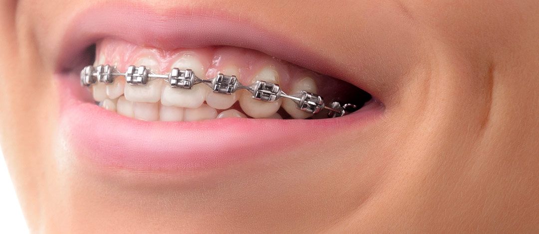 Ortodoncia en Clínica Pastor