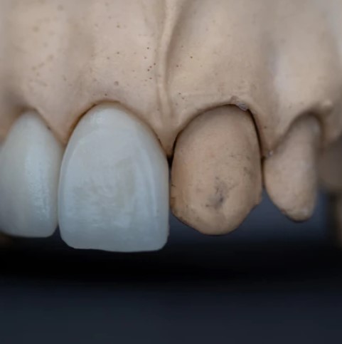 molde de dentadura con dientes oscuros a la derecha y carillas estéticas a la izquierda de color blanco